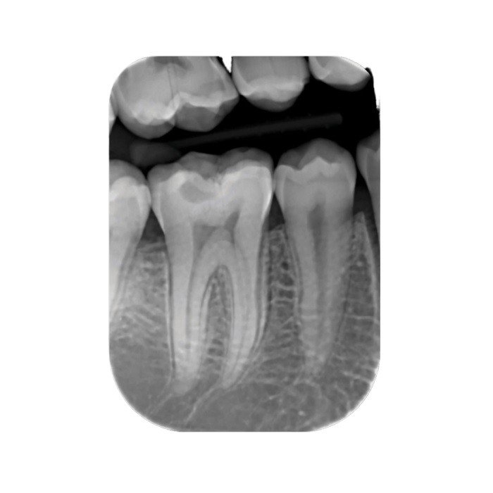 Instrumentarium Focus Intraoral X-ray Imaging - рентгенологическое устройство для различных видов диагностики, размер M с длиной плеча 191 см (США)