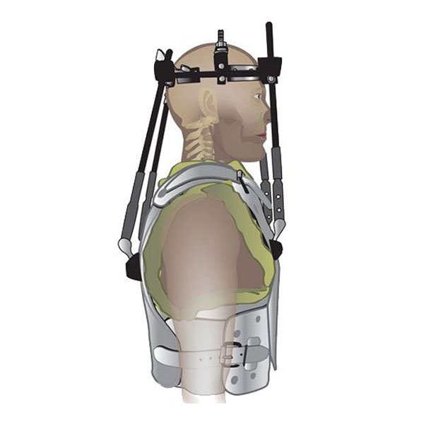 Аппарат "Halo-cast "ЦИТО"-L (большой размер)