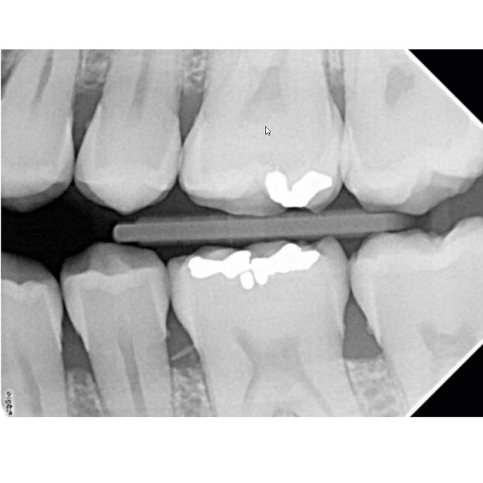 Satelec Комплект рентген и визиограф - рентгеновский аппарат X-Mind DC 80 и визиограф Sopix2 (Франция)