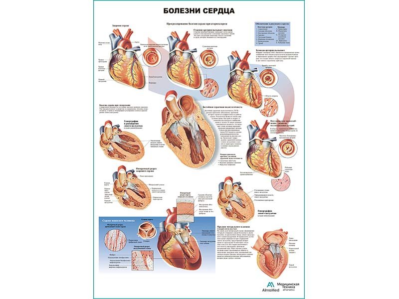 OLD Болезни сердца, плакат глянцевый А1/А2 (глянцевый A1)