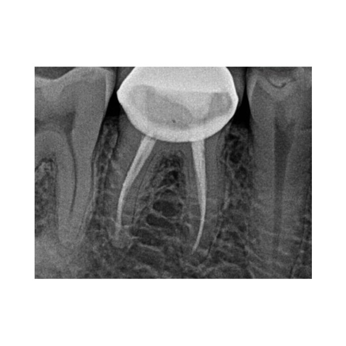 Carestream Dental RVG 5200 - радиовизиограф, 16 пар линий/мм