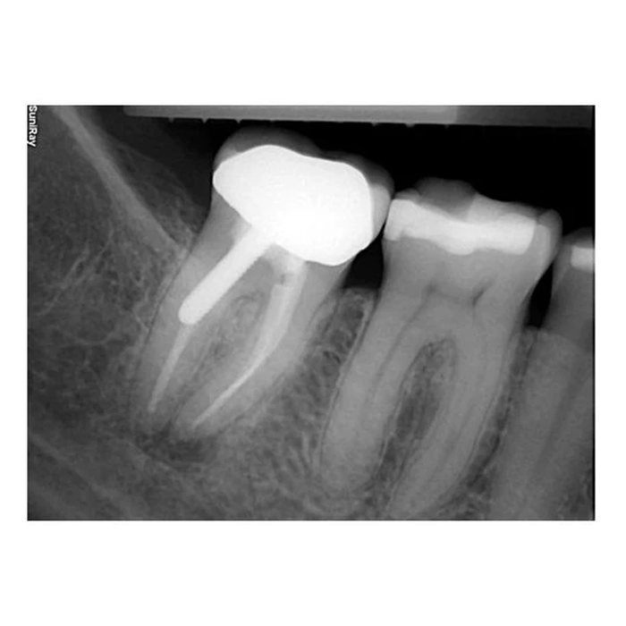 SuniRay2 - система компьютерной радиовизиографии, размер 2