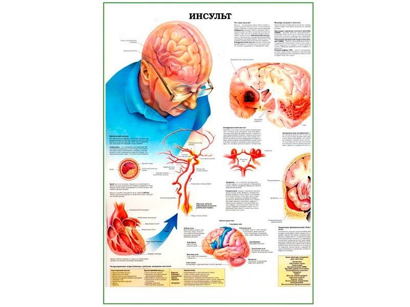 OLD Инсульт, плакат глянцевый А1/А2 (глянцевый A1)