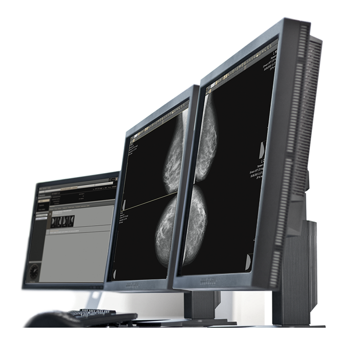 AI-платформа для анализа маммограмм ТриоДМ-МТ