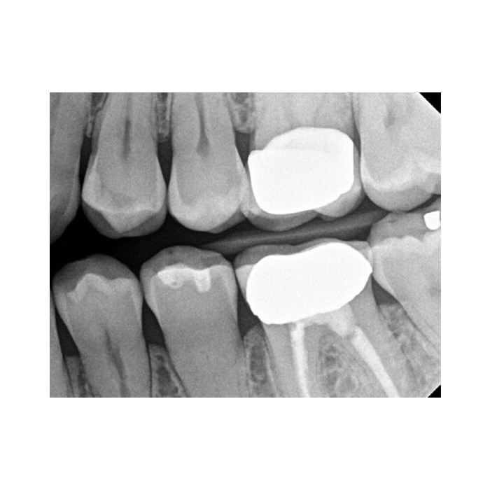 Carestream Dental RVG 6200 - радиовизиограф, 24 пар линий/мм