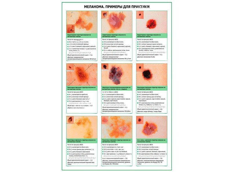 OLD Меланома, примеры для практики, плакат глянцевый А1/А2 (глянцевый A2)