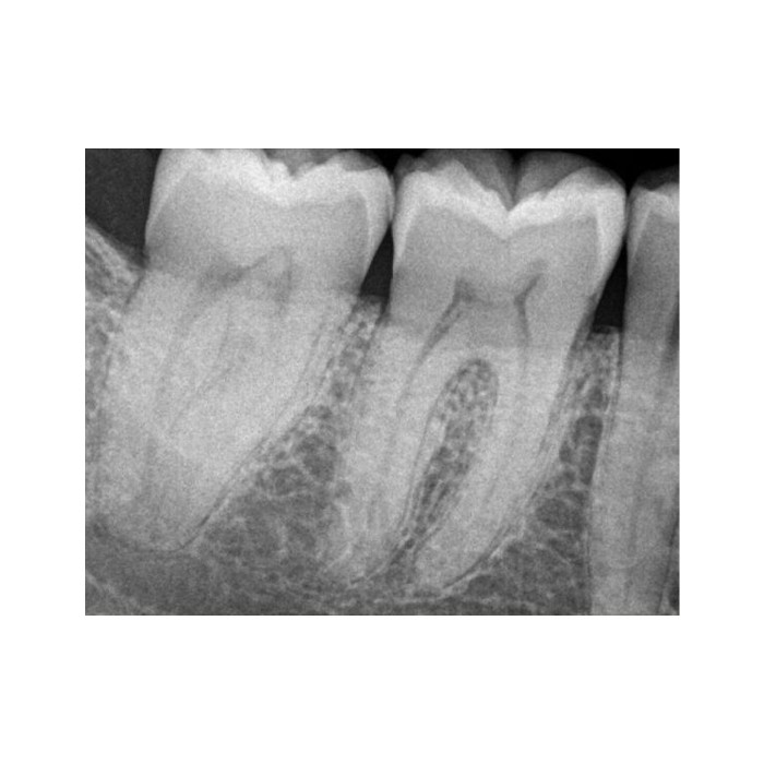 Carestream Dental RVG 6200 - радиовизиограф, 24 пар линий/мм
