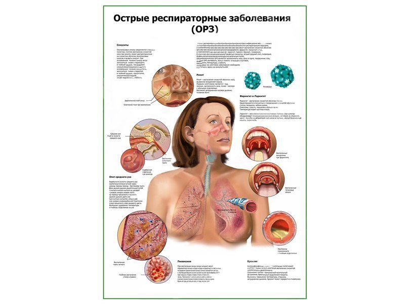 OLD Острые респираторные заболевания плакат глянцевый А1/А2 (глянцевый A1)