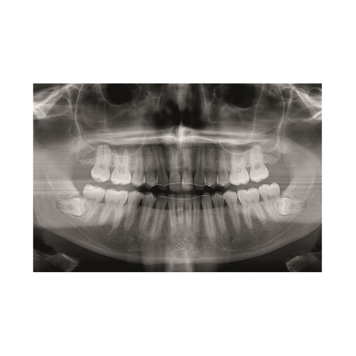 Gendex Pan eXam Plus 2D - дентальный цифровой томограф