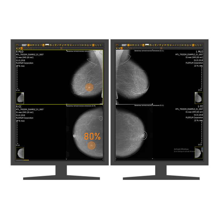 AI-платформа для анализа маммограмм ТриоДМ-МТ