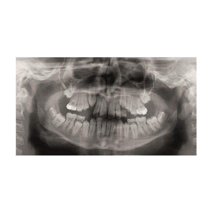 Gendex Pan eXam Plus 2D - дентальный цифровой томограф