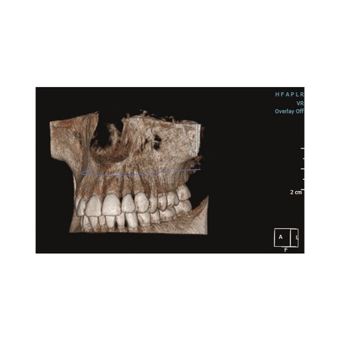 Gendex Pan eXam Plus 2D - дентальный цифровой томограф