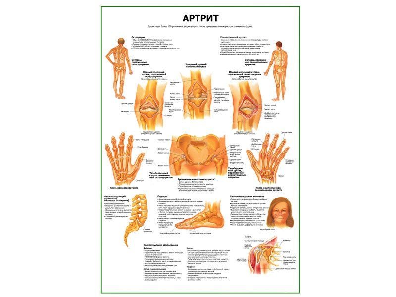 OLD Артрит суставов плакат глянцевый А1/А2 (глянцевый A2)