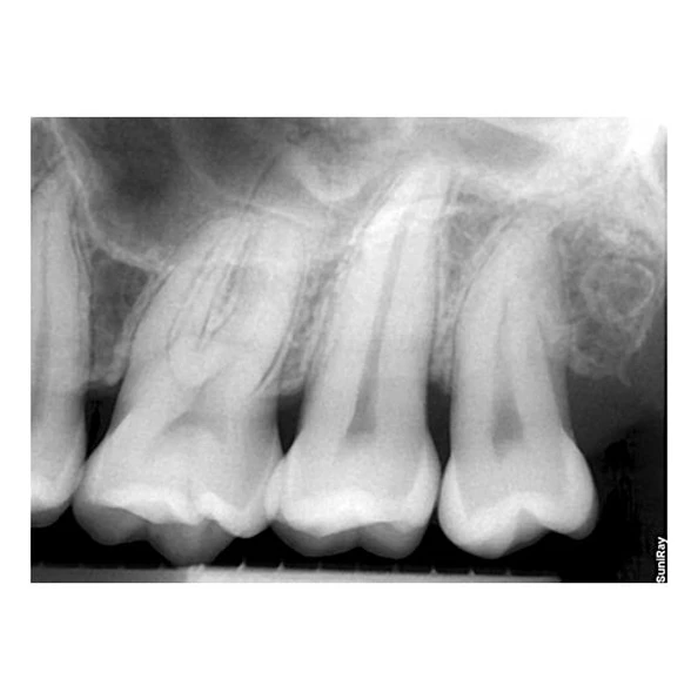 SuniRay2 - система компьютерной радиовизиографии, размер 1