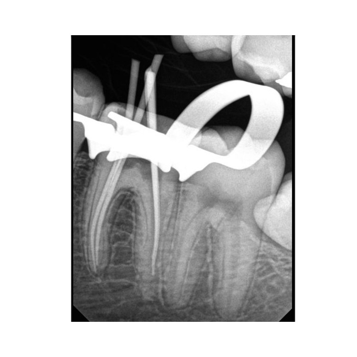 Carestream Dental RVG 6200 - радиовизиограф, 24 пар линий/мм