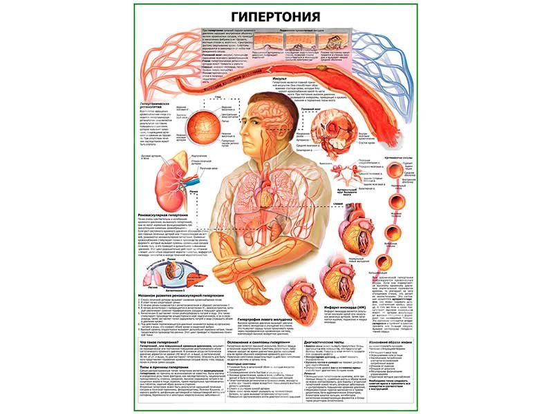 OLD Гипертония плакат глянцевый А1/А2 (глянцевый A2)