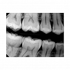 Carestream Dental RVG 6200 - радиовизиограф, 24 пар линий/мм