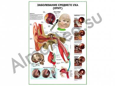 Заболевания среднего уха (отит) плакат ламинированный А1/А2 (ламинированный A2)