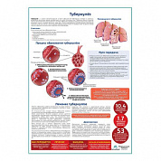 Туберкулёз медицинский плакат А1+/A2+ (глянцевый холст от 200 г/кв.м, размер A1+)