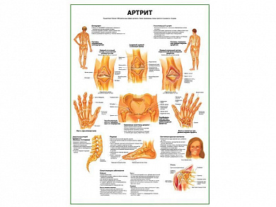 Артрит суставов плакат глянцевый А1/А2 (глянцевый A1)