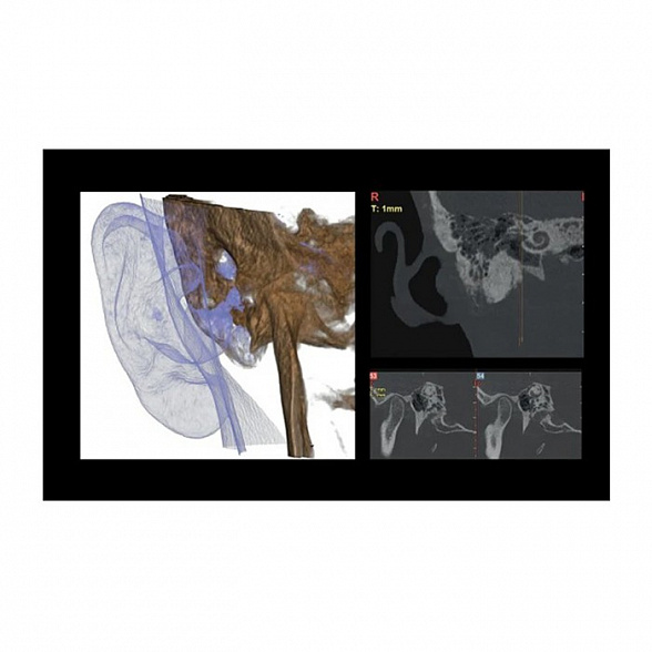 Hyperion X9 Pro 11x13 Ceph Titanium - дентальный цифровой 3D-томограф с цефалостатом, 3 в 1, FOV 11x13