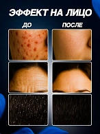 Дарсонваль ДЕ-212 Карат, 4 насадки