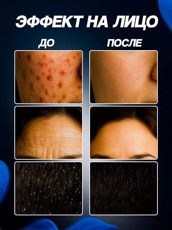 Дарсонваль ДЕ-212 Карат, 4 насадки