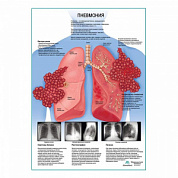 Пневмония плакат глянцевый А1+/А2+ (матовый холст от 200 г/кв.м, размер A1+)