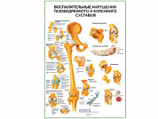 Воспалительные нарушения тазобедренного и коленного суставов плакат глянцевый А1/А2 (глянцевый A1)