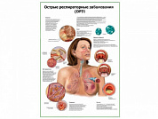 Острые респираторные заболевания плакат глянцевый А1/А2 (глянцевый A2)