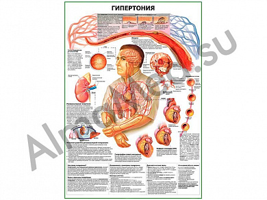 Гипертония плакат ламинированный А1/А2 (ламинированный	A2)