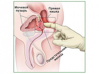 Пальпация предстательной железы, плакат глянцевый/ламинированный А1/А2 (глянцевый	A2)