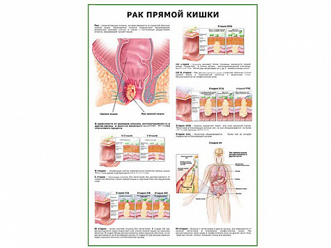Рак прямой кишки плакат глянцевый  А1/А2 (глянцевый A1) Рак прямой кишки плакат глянцевый  А1/А2 (глянцевый A1)
