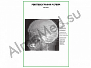Рентгенография черепа. Вид сбоку плакат глянцевый/ламинированный А1/А2 (глянцевый	A2)
