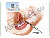 УЗИ предстательной железы, плакат ламинированный А1/А2 (ламинированный	A2)