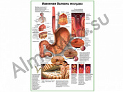 Язвенная болезнь желудка плакат ламинированный А1/А2 (ламинированный A2)