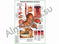Язвенная болезнь желудка плакат ламинированный А1/А2 (ламинированный A2)