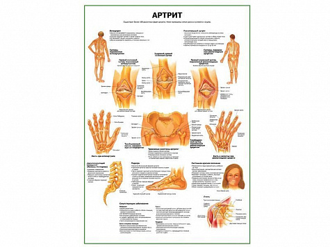 Артрит суставов плакат глянцевый А1/А2 (глянцевый A2)