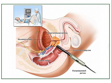 УЗИ предстательной железы, плакат  (глянцевый	A2)