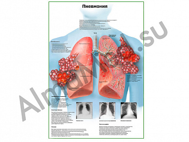 Пневмония плакат глянцевый/ламинированный А1/А2 (глянцевый A2)