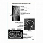 Рентгенография тазобедренного сустава плакат глянцевый А1+/А2+ (глянцевый холст от 200 г/кв.м, размер A1+)
