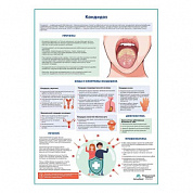 Кандидоз медицинский плакат А1+/A2+ (глянцевая фотобумага от 200 г/кв.м, размер A1+)