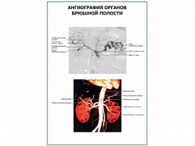 Ангиография органов брюшной полости плакат глянцевый  А1/А2 (глянцевый A2) Ангиография органов брюшной полости плакат глянцевый  А1/А2 (глянцевый A2)