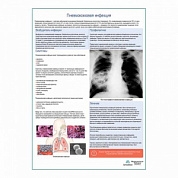 Пневмококковая инфекция медицинский плакат А1+/A2+ (глянцевый холст от 200 г/кв.м, размер A1+)