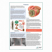 Аскаридоз медицинский плакат А1+/A2+ (глянцевая фотобумага от 200 г/кв.м, размер A2+)