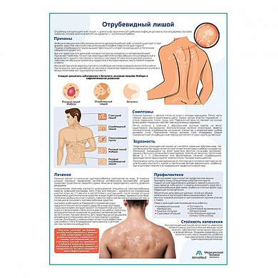 Отрубевидный лишай медицинский плакат А1+/A2+ (глянцевый холст от 200 г/кв.м, размер A1+)