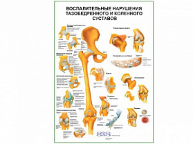 Воспалительные нарушения тазобедренного и коленного суставов плакат глянцевый А1/А2 (глянцевый A2)
