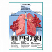 Пневмония плакат глянцевый А1+/А2+ (глянцевая фотобумага от 200 г/кв.м, размер A1+)