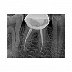 Carestream Dental RVG 5200 - радиовизиограф, 16 пар линий/мм