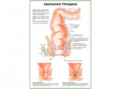 Анальная Трещина плакат глянцевый  А1/А2 (глянцевый A2)